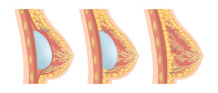 types of breast surgery in kuwait
